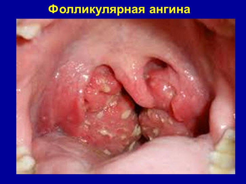 Фолликулярная ангина